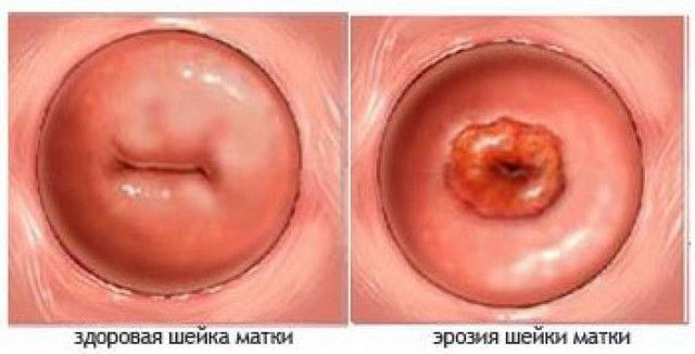 Коричневые выделения в середине цикла признак беременности