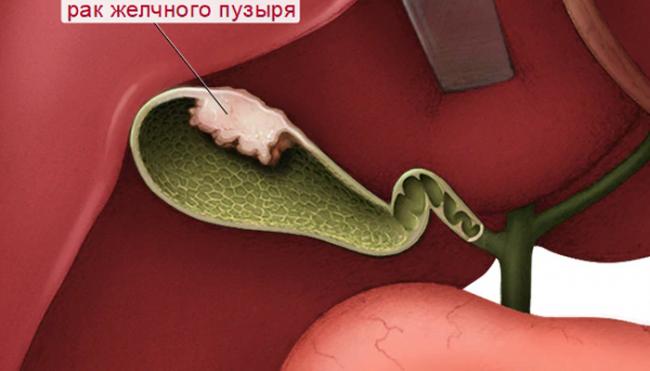 Фиброз печени 1 степени: причины, симптомы, лечение и прогноз