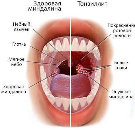 Как лечить хронический тонзиллит без ангины