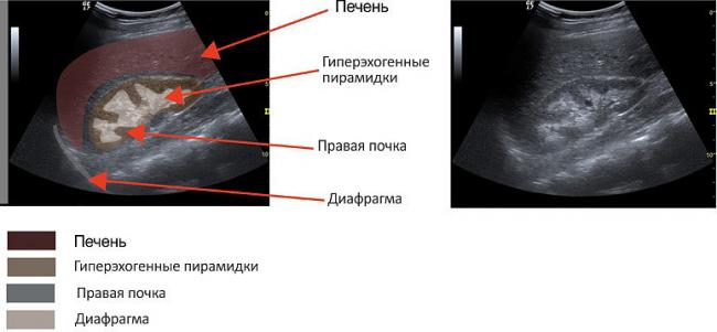 Диета для усиления лечебного эффекта при кисте почки