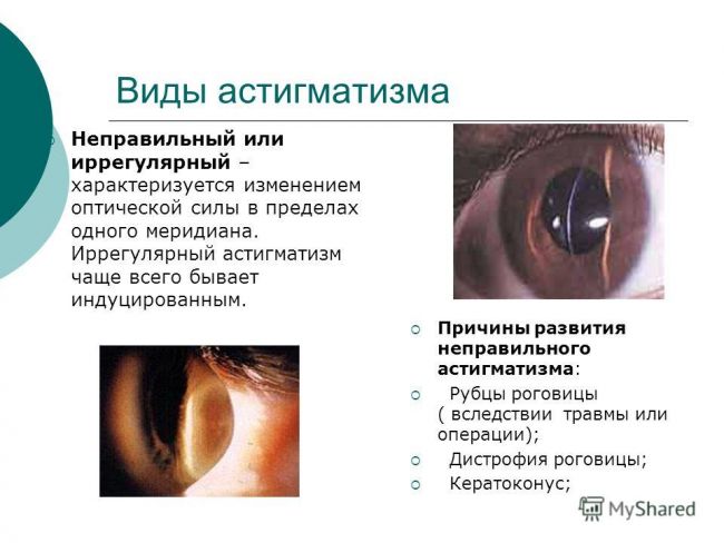 Описание дальнозоркого (гиперметропического) астигматизма и его лечение