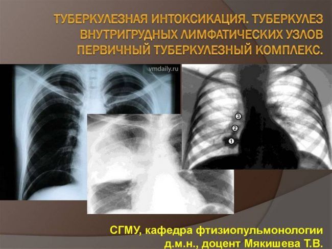 Туберкулез внутригрудных лимфатических узлов | eurolab | инфекционные болезни