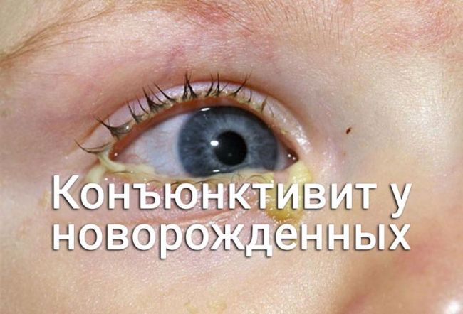 Эффективна ли тетрациклиновая мазь при конъюнктивите? правила применения препарата