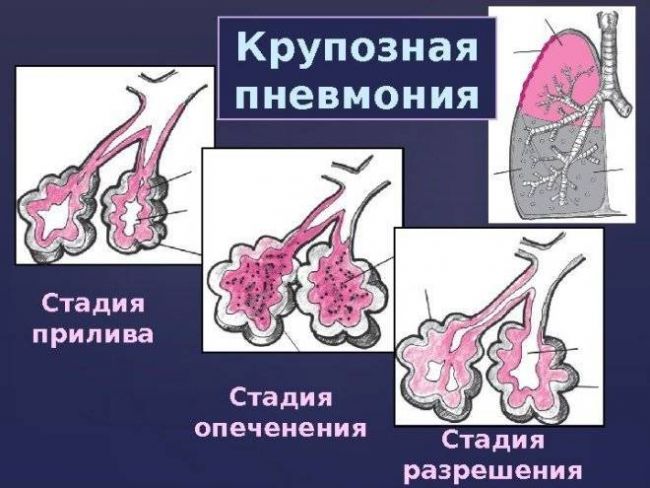 Пневмония и рентген