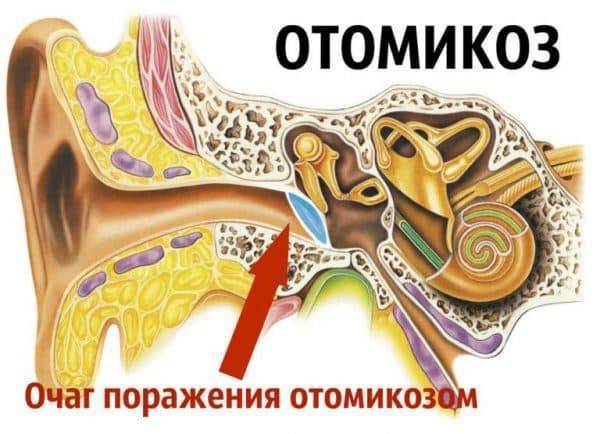 Острый отит: лечение и симптомы