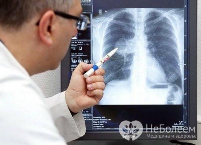 Чего ждать от пневмонии у лежачих больных? кто входит в группу риска?