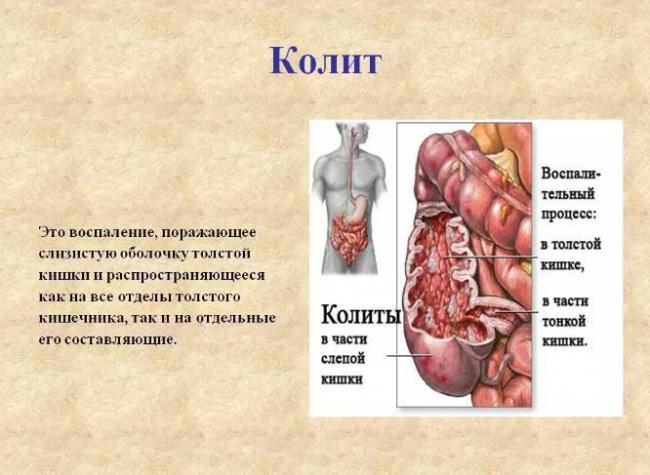 Диета при гастрите желудка и колите