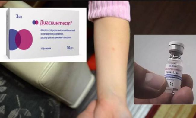 Проба манту на туберкулез и ее нормы у ребенка после введения вакцины