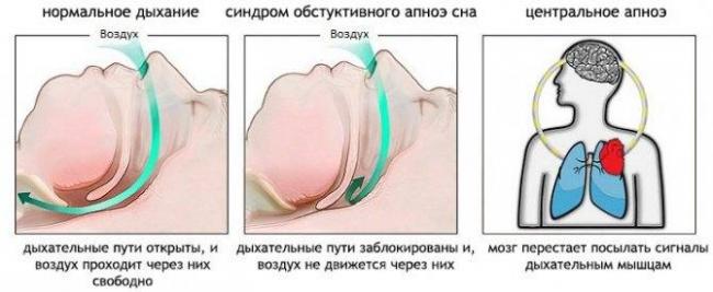 Синдром апноэ сна