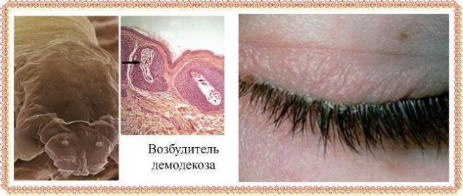 Демодекоз у человека на ресницах