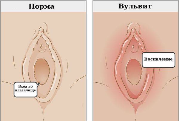 Вульвовагинит у девочек: лечение, симптомы, причины