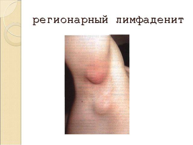 Оценка результатов пробы манту