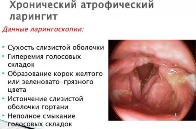 Хронический ларингит: лечение у взрослых