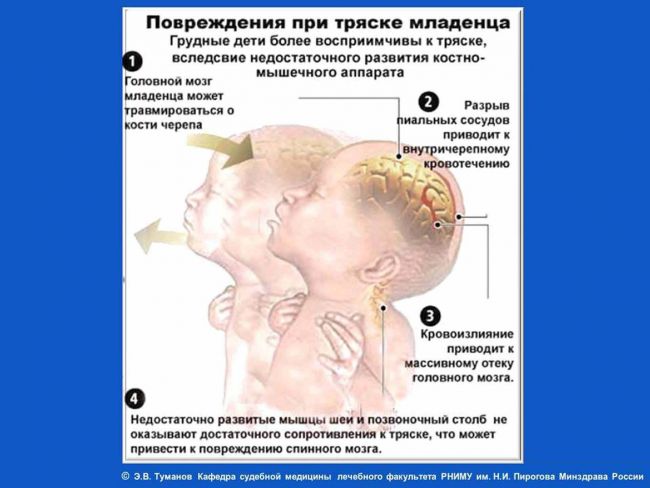 Внутричерепное давление у детей — симптомы и способы лечения