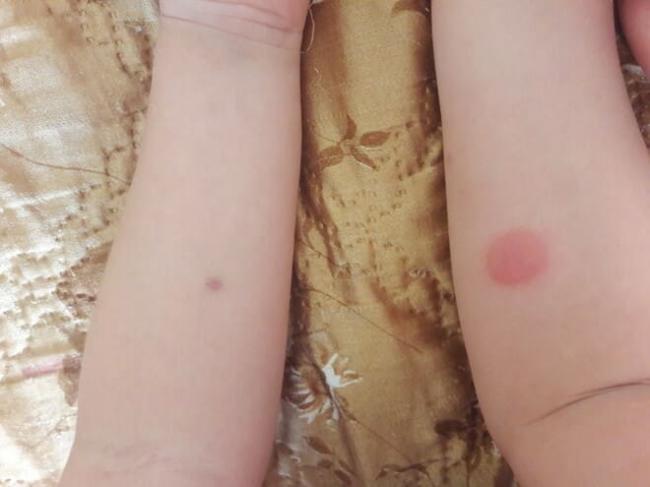 Реакция манту: норма у детей в разном возрасте, таблица, фото