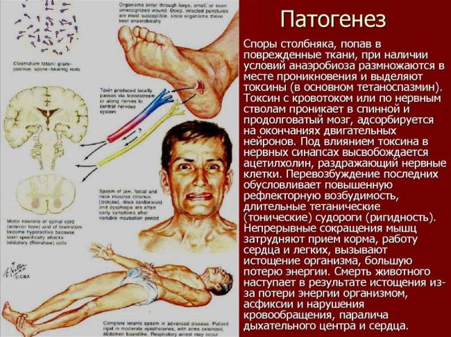Симптомы столбняка у человека