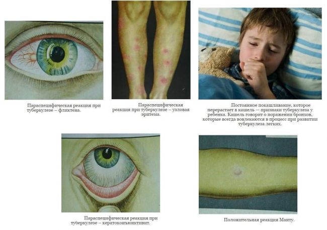 Туберкулез у ребенка. симптомы, как передается, лечение