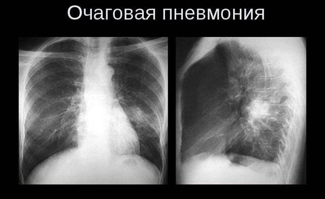 Рентген легких и флюорография легких — все что нужно знать