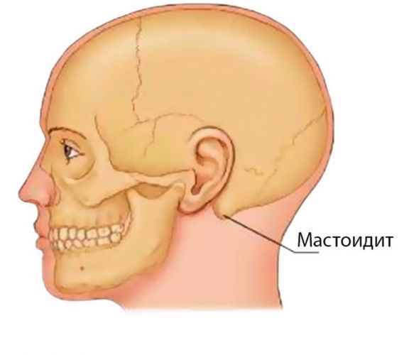 Мастоидит