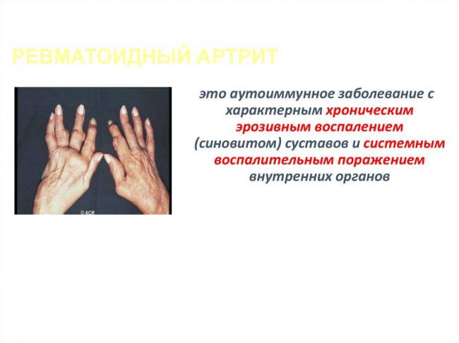 Полиостеоартроз: течение болезни и принципы лечения