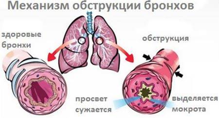 Бронхит у ребенка: симптомы без температуры и лечение