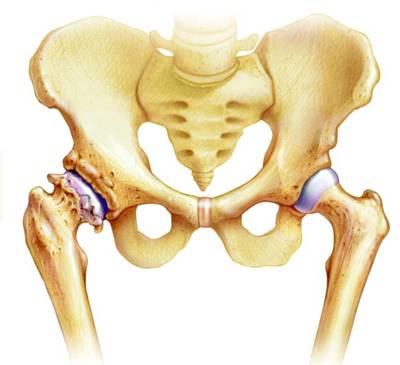 Причины, симптомы синовита коленного сустава, методы диагностики и лечения
