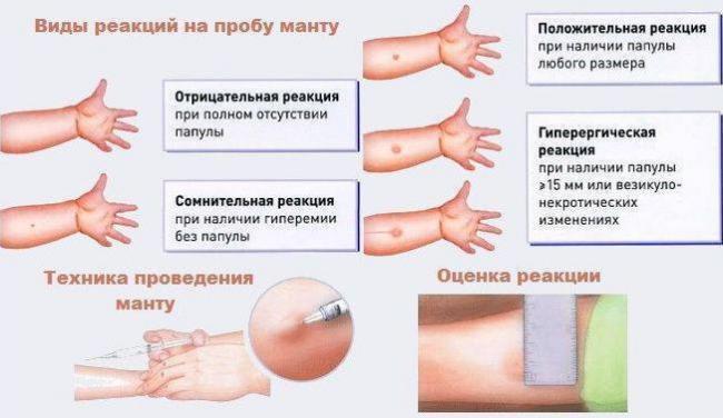 Противопоказания к проведению вакцинации