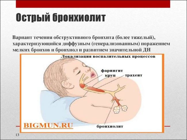 Обструктивный бронхит у детей: симптомы и лечение, клинические рекомендации, причины