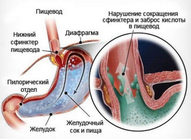 Заболевания глотки и гортани: как различить и чем лечить
