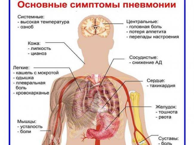 Признаки недолеченной пневмонии