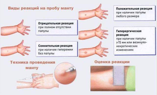 Через сколько после болезни можно ставить манту?