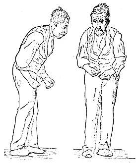 Основные отличия между паркинсонизмом и болезнью паркинсона