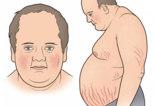 Синдром кушинга: развитие, симптомы, диагноз, лечение