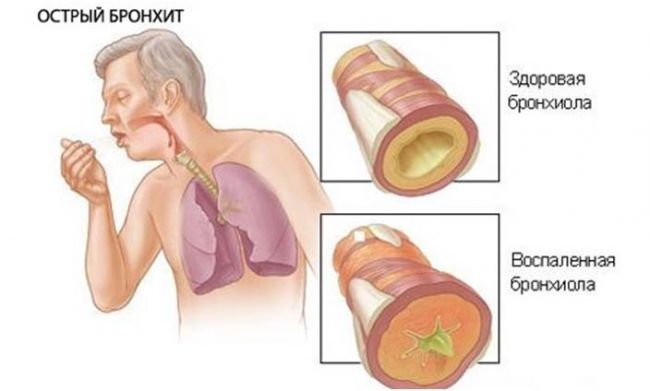 Глава 18. острый бронхит