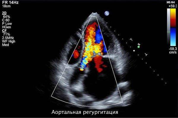 Трикуспидальная регургитация 1 степени что это такое