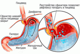 Симптомы и лечение гастроэзофагеальной рефлюксной болезни (гэрб)