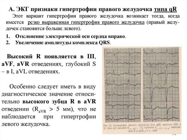 Гипертрофия левого желудочка сердца – причины, лечение, симптомы на экг. чем опасна гипертрофия левого желудочка сердца?