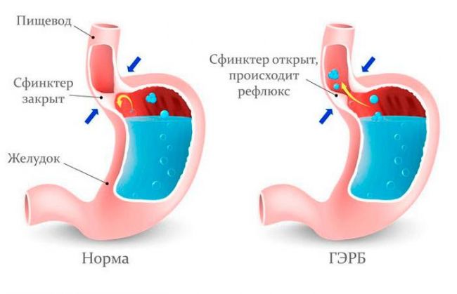 Гастроэзофагеальная рефлюксная болезнь: причины, лечение, профилактика, диагностика, симптомы