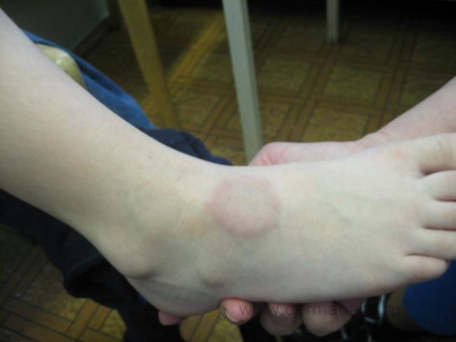 Кольцевидная гранулёма