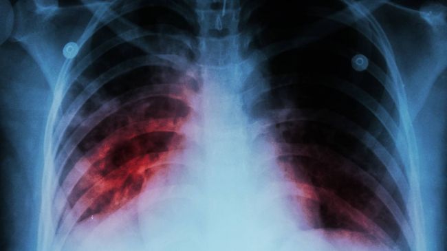 Mycobacterium tuberculosis
