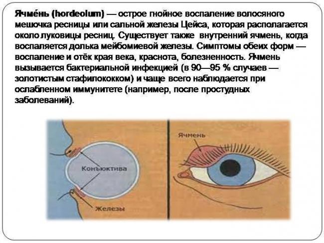 Как избавиться от ячменя на глазу: 10 простых домашних средств