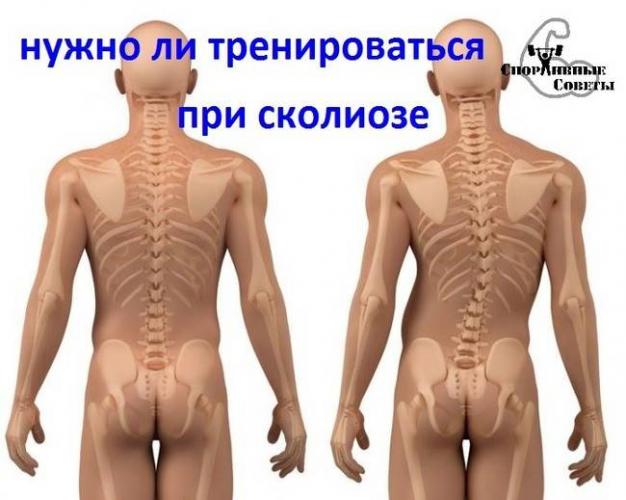 Как лечить искривление позвоночника поясничного отдела