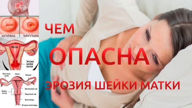 Симптомы при эрозии шейки матки у женщин
