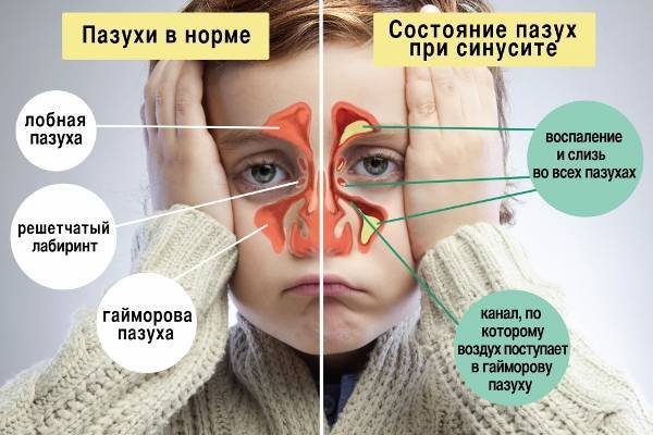 Кашель с одышкой после физической нагрузки у ребенка