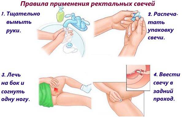 Свечи и мазь постеризан: инструкция по применению, цена, отзывы, аналоги и что лучше?