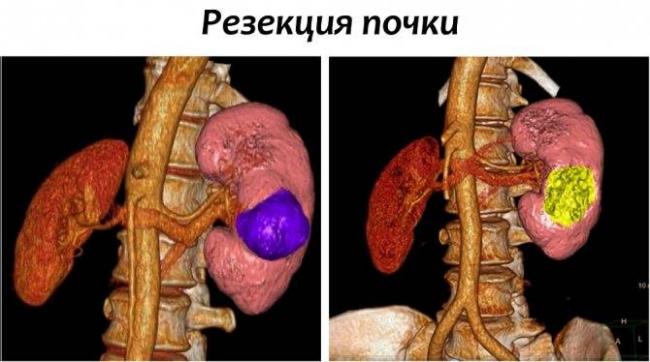Признаки кисты почки и методы лечения заболевания