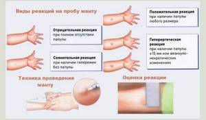 Реакция манту: норма у детей в 4 года, таблица оценки, допустимый размер пробы
