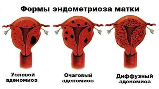 Очаговый аденомиоз