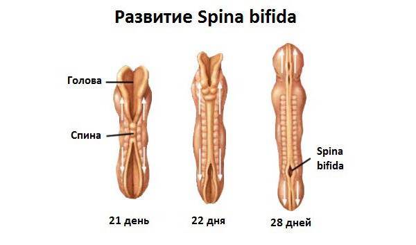 Спина бифида у новорожденных детей