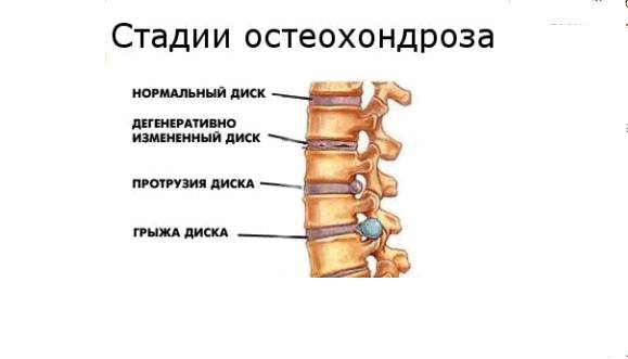 Лечение шейного остеохондроза в домашних условиях: народные методы